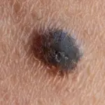 Personalized mRNA Therapy Marks a Turning Point in the Fight Against Skin Cancer